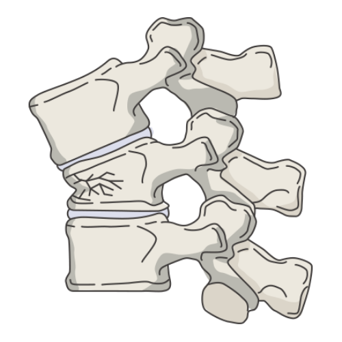 圧迫骨折になった椎体