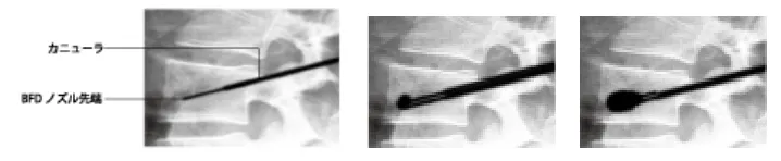 椎体に挿入した風船が膨らんでいく様子